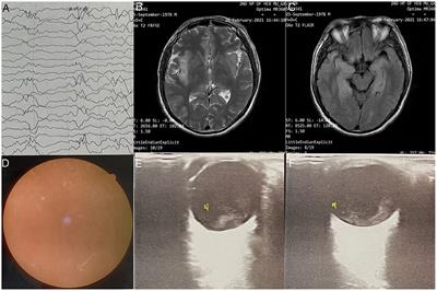 Human Encephalitis Complicated With Ocular Symptoms Associated With Pseudorabies Virus Infection: A Case Report